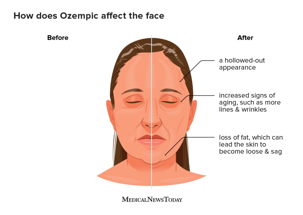 Preventing and Managing 'Ozempic Face' - Rightangled